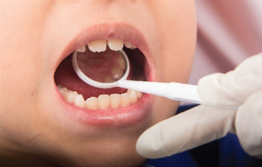 Niềng răng cho trẻ quá sớm, sau này có phải niềng lại?