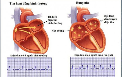 Lương thấp, đãi ngộ kém làm tăng 97% nguy cơ rung nhĩ