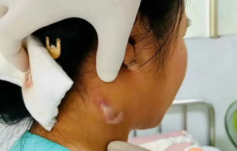 Đồng Nai ghi nhận ca bệnh 'vi khuẩn ăn thịt người' đầu tiên