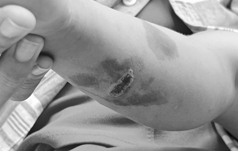 Mới vào học, trẻ mắc bệnh chốc tăng nhanh