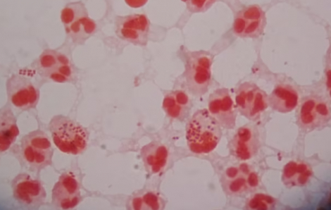 Anh cảnh báo sự gia tăng bệnh lậu kháng thuốc kháng sinh