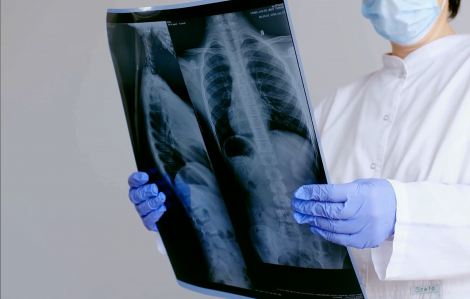 1 người tử vong do cúm ở Bình Định