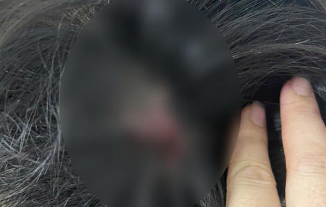 Nam sinh lớp 9 ở Bến Tre bị đánh hội đồng dập não