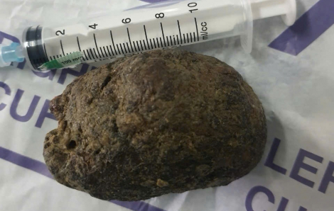 Bị tắc ruột sau khi ăn 3 quả hồng ngâm