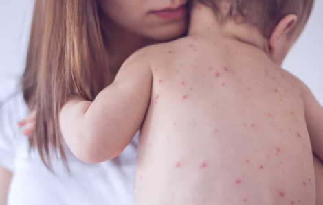 TPHCM ghi nhận số ca bệnh sởi tăng kỷ lục trong tuần