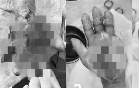 Từ vết ngứa nhỏ, người phụ nữ phải tháo ngón tay vì hoại tử