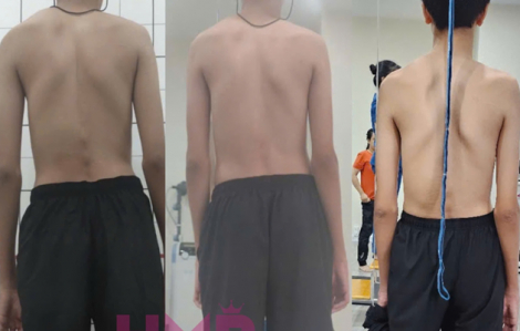 Hội chứng Marfan khiến bé 14 tuổi cao 1,95m