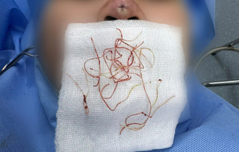 Hoại tử, nhiễm khuẩn nặng vì nâng mũi bằng chỉ tại spa