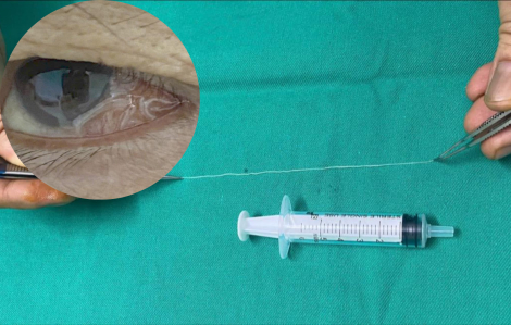 Gắp con giun dài 14cm khỏi mắt bệnh nhân 68 tuổi