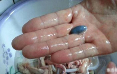 2 người bị suy thận sau khi uống mật cá tăng cường sức khỏe