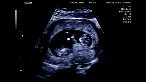 Cặp song sinh tại Hà Nội chào đời cách nhau 5 tuần