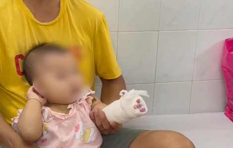 Bé gái 14 tháng bị bỏng nặng do té vào nồi lẩu đang sôi