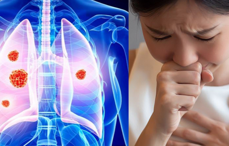 Số ca ung thư phổi gia tăng ở những người phụ nữ chưa bao giờ hút thuốc lá