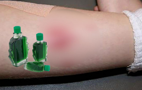 Nhiễm trùng da nghiêm trọng vì bôi dầu nóng