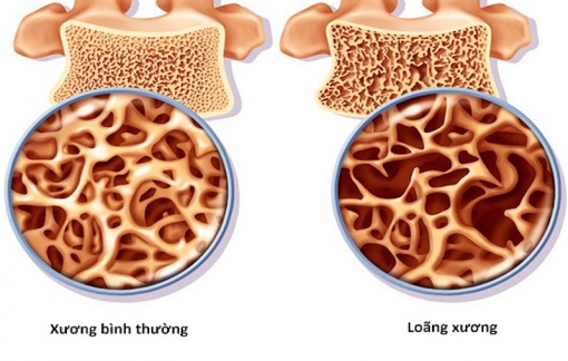 Làm sao phát hiện mình bị loãng xương?