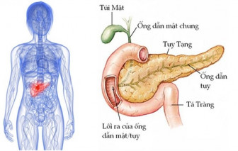 Xét nghiệm máu giúp phát hiện ung thư tuyến tụy chính xác 85%