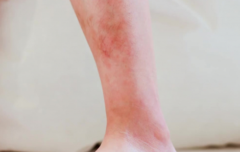 Vết đỏ trên da có thể là dấu hiệu cảnh báo ung thư