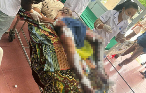 Bị bỏng nặng do điện thoại trong túi quần phát nổ