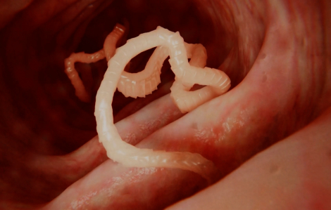 Co giật, méo miệng vì sán làm tổ trong não