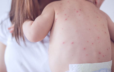 Ca bệnh sởi trên cả nước tăng nhanh, một phần do nhiều người "anti" vắc-xin