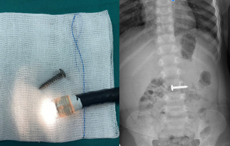 Cứu cháu bé 34 tháng tuổi nuốt phải cây đinh vít