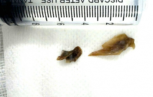 Người đàn ông bị 2 mảnh xương rơi vào trong phổi gây biến chứng kéo dài