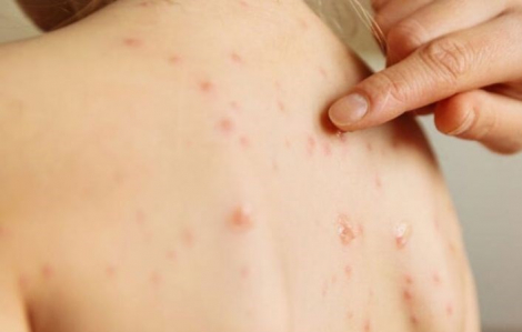 Bộ Y tế lập 6 đoàn kiểm tra các địa phương có số ca mắc sởi tăng cao