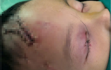 Bé 3 tuổi bị chó hàng xóm tấn công, phải khâu hàng chục mũi