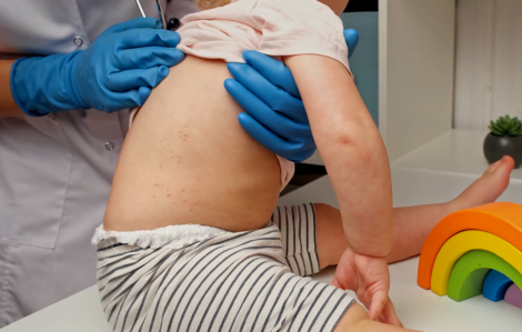 Đà Nẵng: Hơn 25% ca mắc sởi đã tiêm ít nhất 1 mũi vắc xin