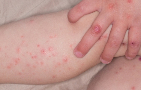 Bệnh tay chân miệng ở Hà Nội tăng gần gấp 2 cùng kỳ