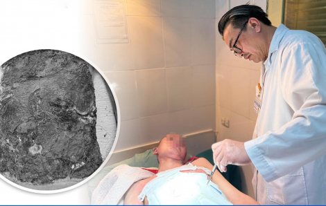 Nam sinh bị nhiễm trùng nặng sau khi đắp thuốc nam chữa bỏng