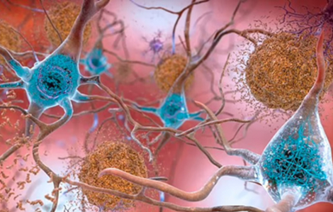 Bệnh Alzheimer có thể truyền qua nhiều thế hệ