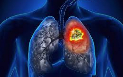 Khởi động nghiên cứu căn bệnh ung thư phổ biến thứ 2 ở Việt Nam