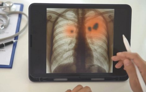 Ung thư phổi có tỷ lệ sống sau 5 năm chỉ đạt khoảng 15%