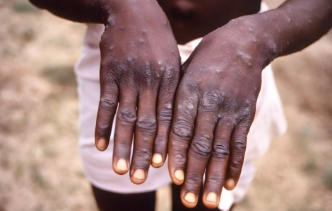 Các trường hợp mắc đậu mùa khỉ tăng mạnh ở châu Phi