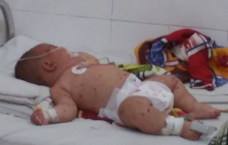 Hà Nội ghi nhận ca mắc não mô cầu đầu tiên trong năm