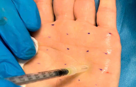 Khổ sở vì bàn tay luôn ướt