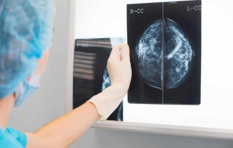 Số ca mắc và tử vong do ung thư vú dự kiến ​​tăng vọt trên toàn thế giới