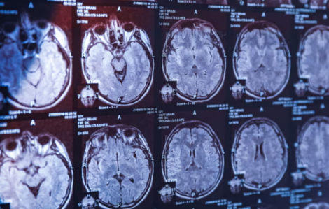 Xét nghiệm máu có thể phát hiện bệnh Parkinson trước khi các triệu chứng xuất hiện