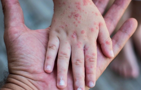 TPHCM thêm nhiều khu vực hết dịch sởi, Hà Nội số ca mắc gia tăng