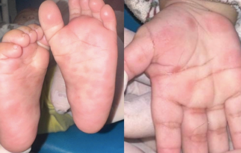 Bé trai 4 tháng tuổi mắc giang mai bẩm sinh