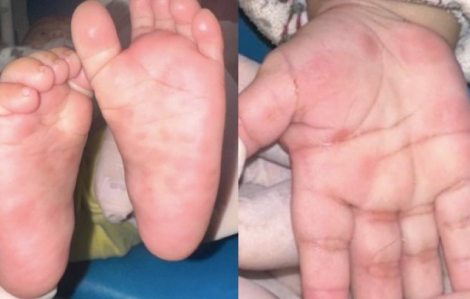 Tin tức ngày 16/4: Bé trai 4 tháng tuổi mắc giang mai bẩm sinh