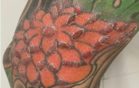 Nam thanh niên nhập viện sau khi xăm kín 2 cẳng chân