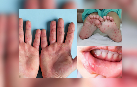 Số ca mắc tay chân miệng ở TPHCM tăng mạnh