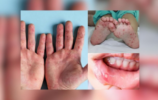 Tin tức ngày 21/4: Số ca mắc tay chân miệng ở TPHCM tăng mạnh