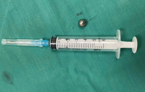 Cứu bé trai 5 tuổi bị bi sắt từ súng đồ chơi bắn xuyên mặt