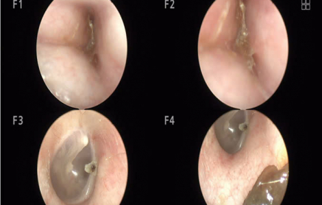 Người phụ nữ bỗng nhiên nghe kém vì bệnh hiếm gặp