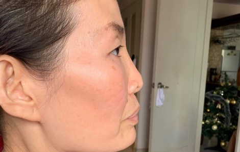 Hoa hậu Diễm Kyly kiện trung tâm thẩm mỹ vì sửa mũi xấu