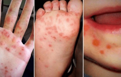 Hà Nội ghi nhận gần 300 ca tay chân miệng trong tuần