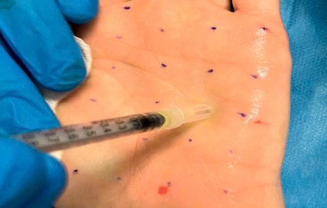 Khổ sở vì bàn tay luôn ướt